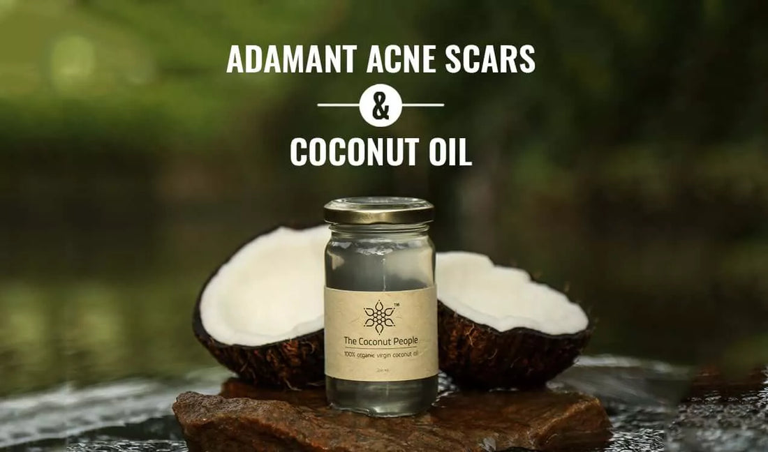 Adamant Acne Scars & Coconut Oil